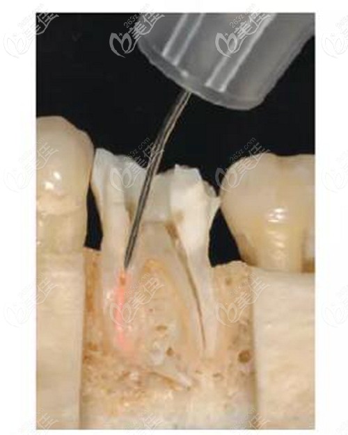 熱牙膠填充的優(yōu)點(diǎn)