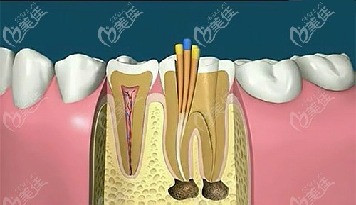 冷牙膠填充的優(yōu)點(diǎn)