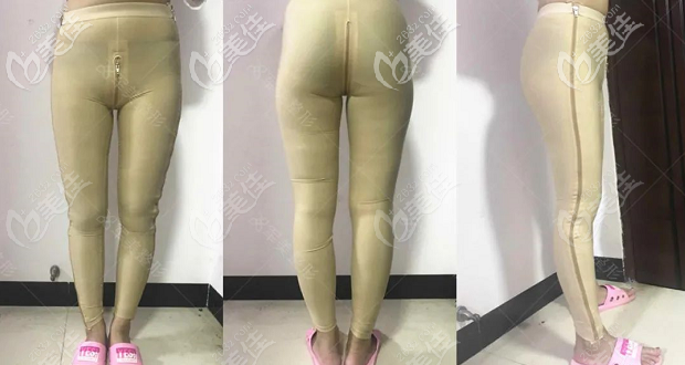 我做大腿抽脂肪花了14800多元