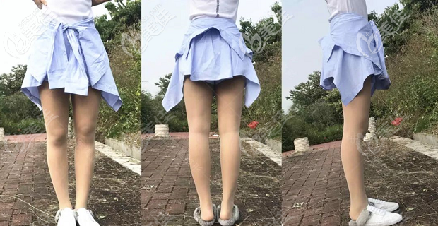 做腿部吸脂手術(shù)2個(gè)月效果