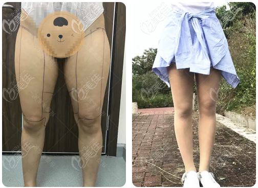 做腿部吸脂術(shù)大約多少錢？我做大腿抽脂肪花了14800多元