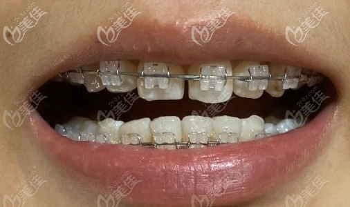 陶瓷半隱形牙套 陶瓷半隱形牙套