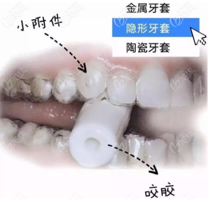隱形牙套咬膠使用圖示 隱形牙套咬膠使用圖示