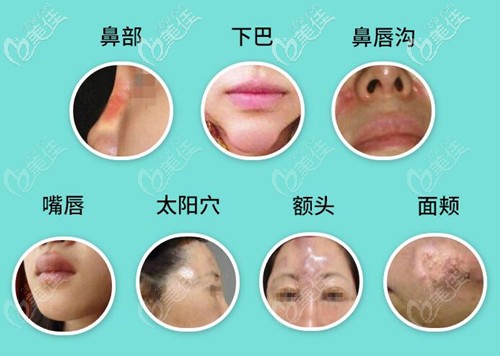 奧美定常見部位