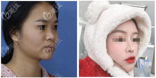 甘泉涌鼻綜合案例