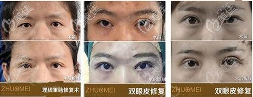 王海平院長(zhǎng)雙眼皮修復(fù)手術(shù)對(duì)比圖