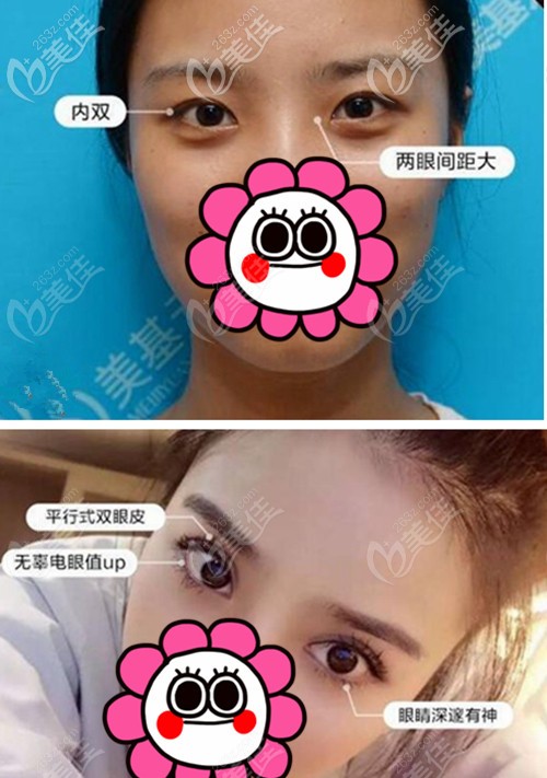項(xiàng)利姣院長(zhǎng)內(nèi)雙做雙眼皮對(duì)比圖