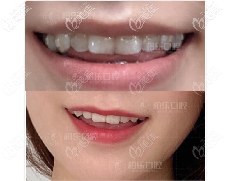 隱適美地包天矯正中