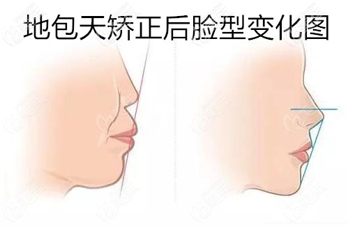 地包天矯正后臉型圖
