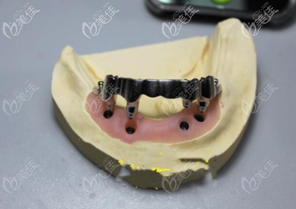 桿卡半固定種植牙