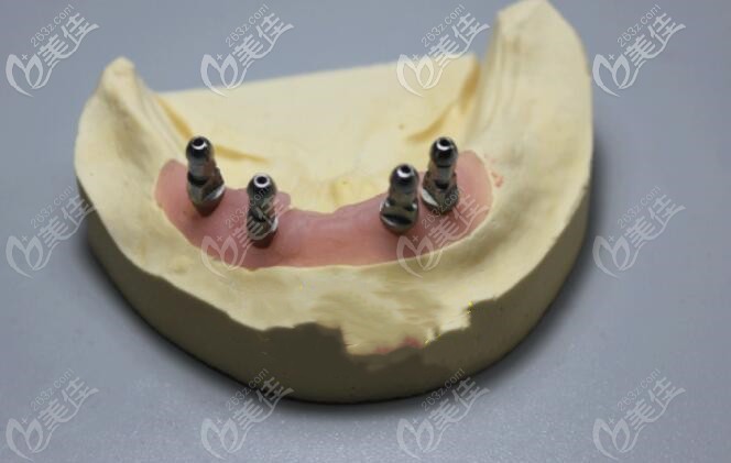 球帽半固定種植牙，也叫球帽覆蓋義齒