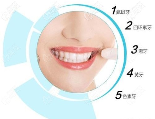 皓齒美白可以改善的牙齒問題