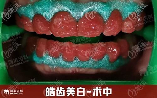 在博美口腔做皓齒美白中
