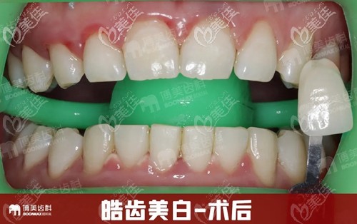 在博美口腔做皓齒美白后即刻效果