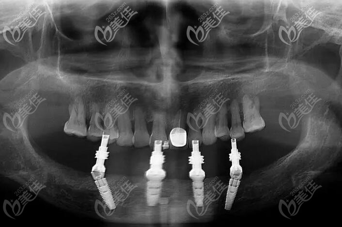 下半口用allon4種植的CT照片