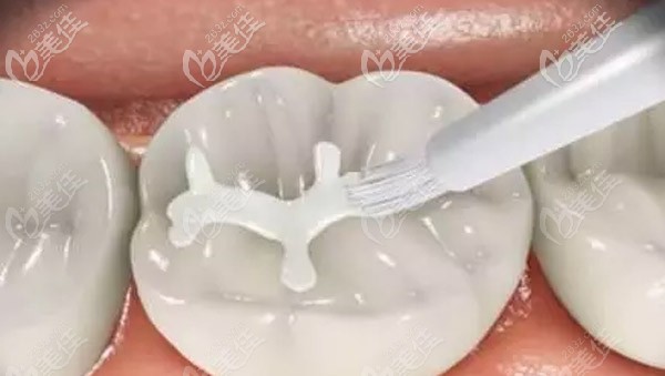 要及時(shí)對六齡齒進(jìn)行涂氟