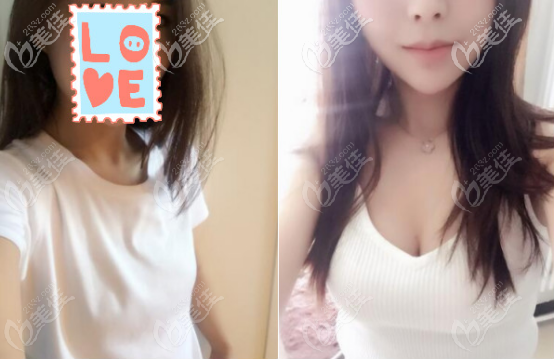 分解自體脂肪隆胸全過(guò)程，并告訴你體脂率多高才能做自體脂肪隆胸