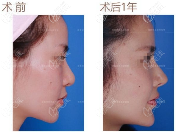 通過鼻修復(fù)看歐陽春鼻子做的怎么樣