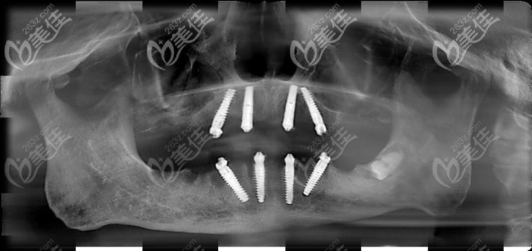 70歲老人在馬瀧齒科做allon4滿口種植牙后的CT 70歲老人在馬瀧齒科做allon4滿口種植牙后的CT
