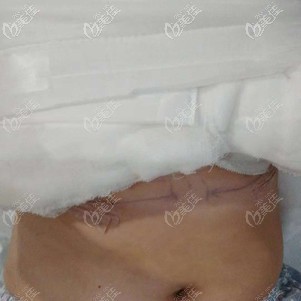 隆胸術(shù)后包裹的很?chē)?yán)實(shí)