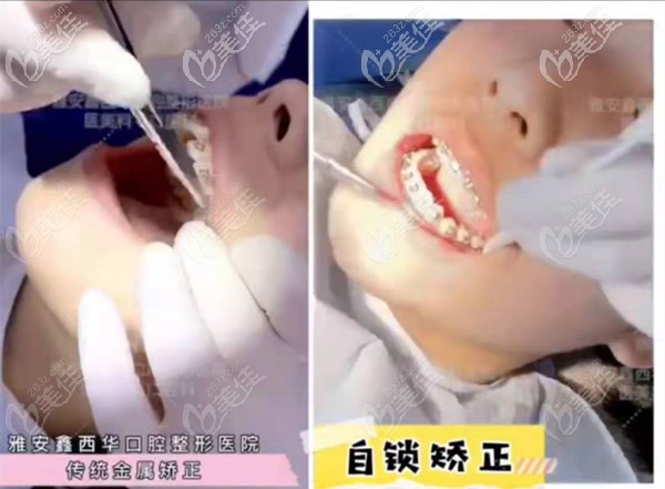雅安鑫西華口腔醫(yī)院牙齒矯正