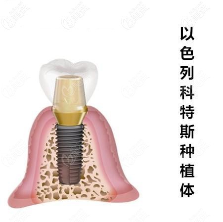 以色列科特斯cortex種植體 以色列科特斯cortex種植體