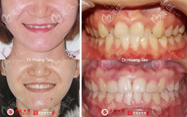 反頜矯正前后的正面臉型照和牙齒圖 反頜矯正前后的正面臉型照和牙齒圖
