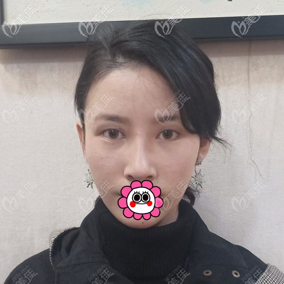 找杭州藝星歐陽帆做雙眼皮前 找杭州藝星歐陽帆做雙眼皮前