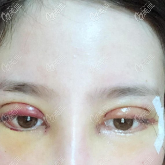 雙眼皮術(shù)后三天<span style= 雙眼皮術(shù)后三天<span style=