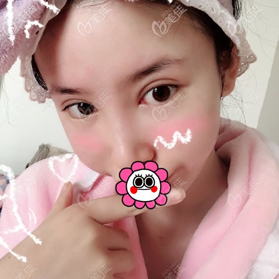 雙眼皮術(shù)后15天恢復(fù)<span style= 雙眼皮術(shù)后15天恢復(fù)<span style=