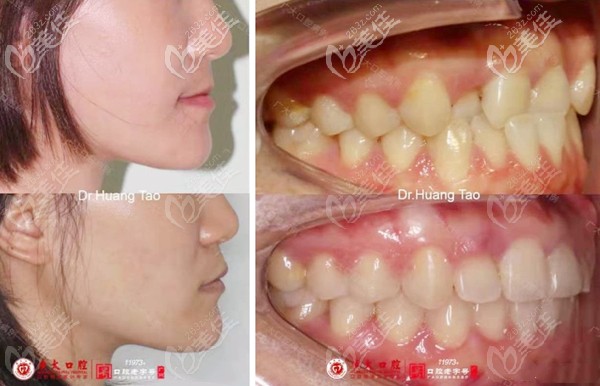 地包天矯治前后臉型的改變圖 地包天矯治前后臉型的改變圖