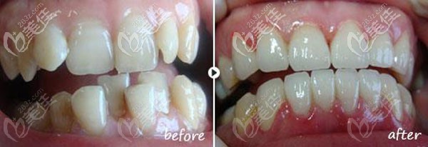 牙齒矯正圖片前后對比