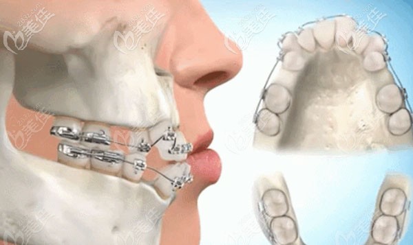 正畸失敗的原因