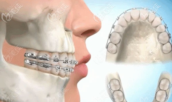 正畸失敗會出現(xiàn)的癥狀