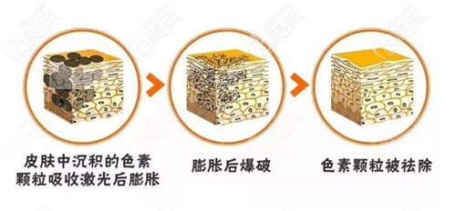激光祛斑的原理 激光祛斑的原理