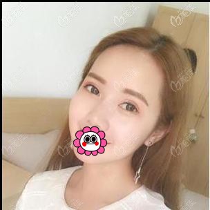 寧波郭光燁做雙眼皮手術(shù)怎么樣？看我花了近五千元的效果如何