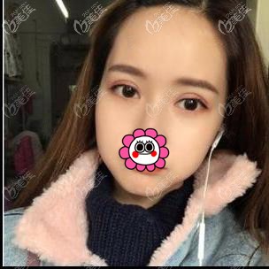 雙眼皮7天拆線后