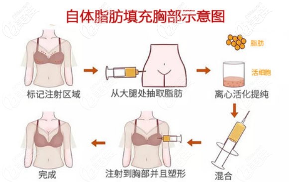 自體脂肪豐胸手術(shù)過程