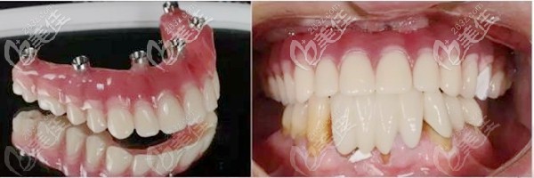 allon6種植技術案例 allon6種植技術案例