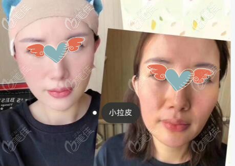 45歲做完小拉皮前后對比照片