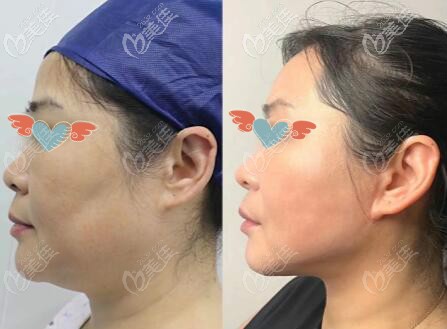 56歲做完面部小拉皮切口效果圖片