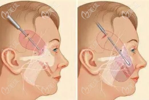 小切口拉皮手術切口位置和手術原理
