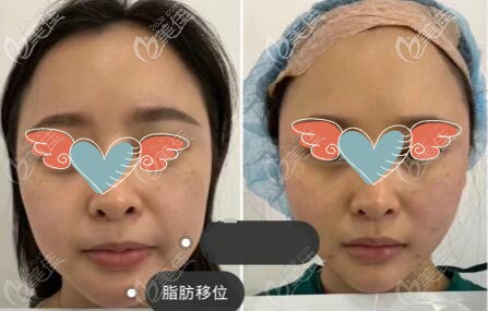 歐薇拉脂肪移位效果對比圖