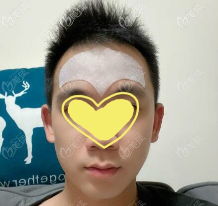 男士用抬頭紋貼去除額頭抬頭紋照片