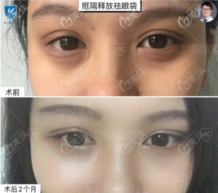 重慶百達麗別箏醫(yī)生眶隔釋放去眼袋效果圖 重慶百達麗別箏醫(yī)生眶隔釋放去眼袋效果圖