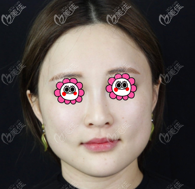 在北京星燦宮做面部吸脂前 在北京星燦宮做面部吸脂前