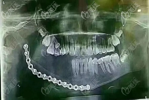 做完下頜骨切除手術后的CT