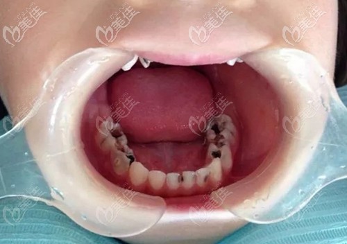 乳牙齲壞一定要及時治療