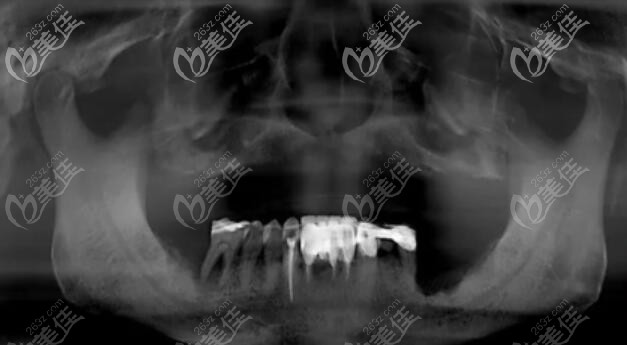 取下活動(dòng)義齒后口腔狀況.jpg 取下活動(dòng)義齒后口腔狀況.jpg