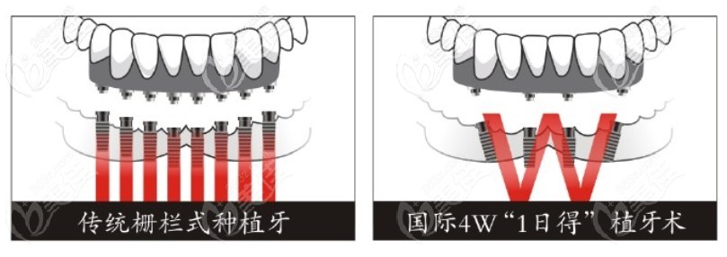 網(wǎng)上找的傳統(tǒng)柵欄式種植牙和allon4種植牙對(duì)比圖 網(wǎng)上找的傳統(tǒng)柵欄式種植牙和allon4種植牙對(duì)比圖